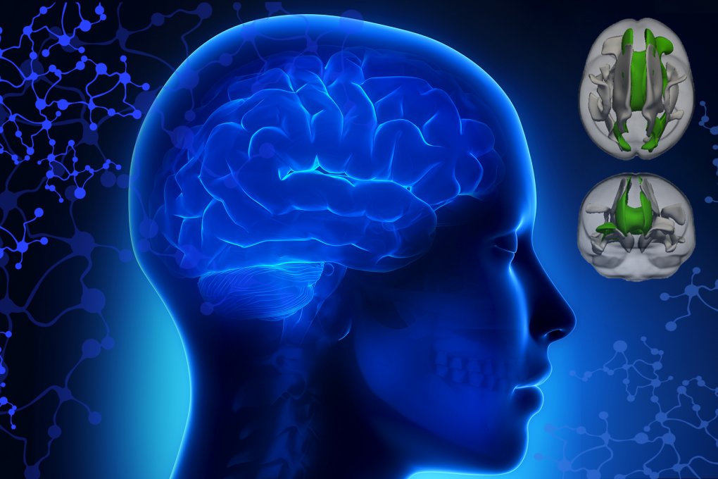Illustration of the brain connectome in ADHD